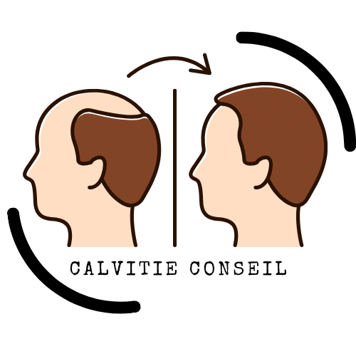 Calvitie Conseil